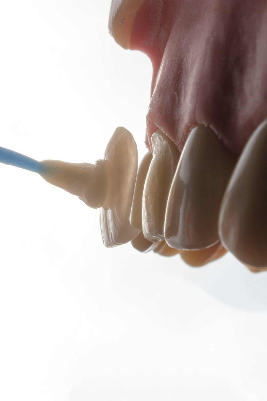 Diseño de sonrisa y estética dental - detalle