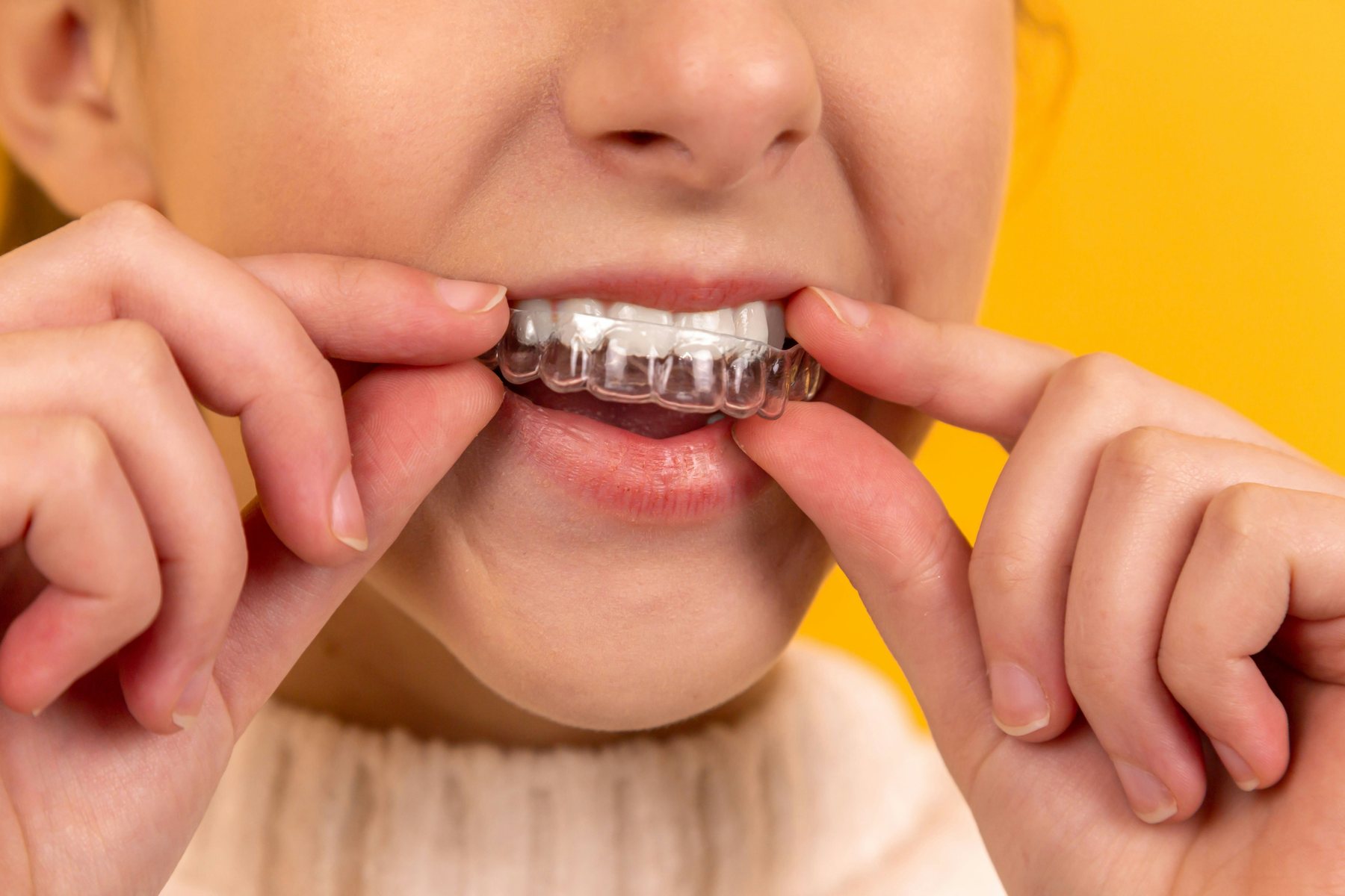 Ortodòncia invisible Invisalign al Bages