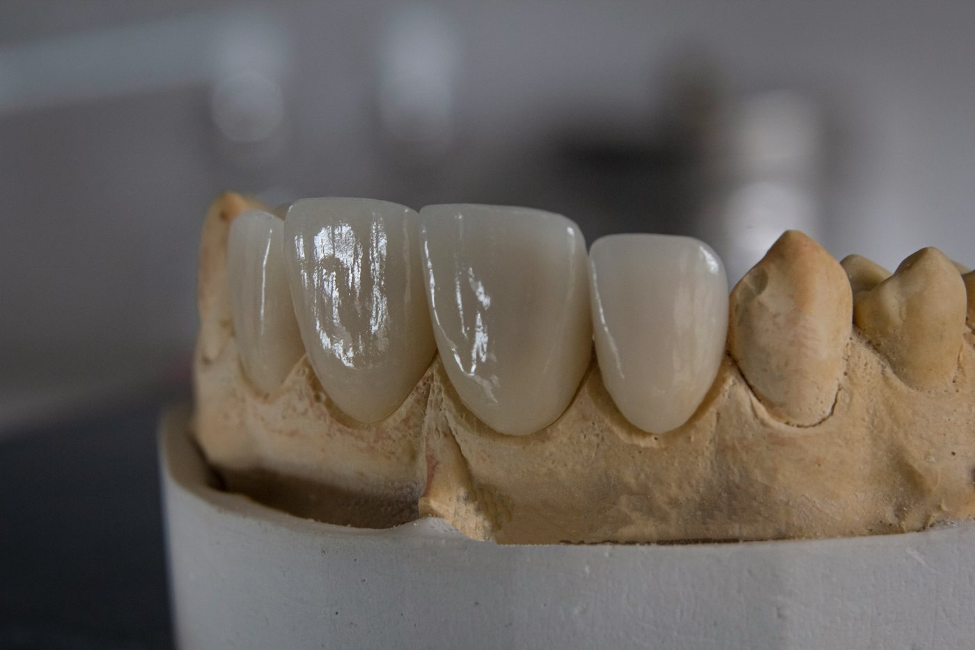 Prótesis y rehabilitación oral - detalle